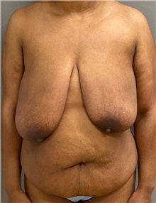 Tummy Tuck Before Photo by Keshav Magge, MD; Bethesda, MD - Case 49562