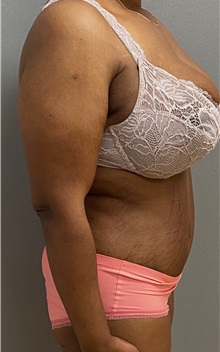 Tummy Tuck After Photo by Keshav Magge, MD; Bethesda, MD - Case 49562
