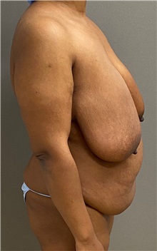 Tummy Tuck Before Photo by Keshav Magge, MD; Bethesda, MD - Case 49562