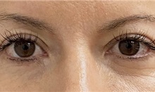 Eyelid Surgery After Photo by Keshav Magge, MD; Bethesda, MD - Case 49564