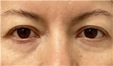 Eyelid Surgery Before Photo by Keshav Magge, MD; Bethesda, MD - Case 49564