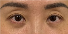 Eyelid Surgery After Photo by Keshav Magge, MD; Bethesda, MD - Case 49559