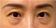 Eyelid Surgery Before Photo by Keshav Magge, MD; Bethesda, MD - Case 49559