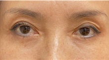 Eyelid Surgery After Photo by Keshav Magge, MD; Bethesda, MD - Case 49569