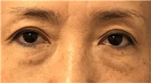 Eyelid Surgery Before Photo by Keshav Magge, MD; Bethesda, MD - Case 49569