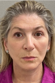 Facelift After Photo by Keshav Magge, MD; Bethesda, MD - Case 49572