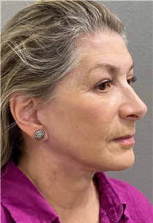 Facelift After Photo by Keshav Magge, MD; Bethesda, MD - Case 49572