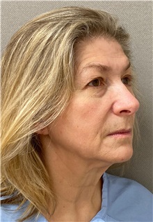 Facelift Before Photo by Keshav Magge, MD; Bethesda, MD - Case 49572