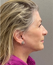 Facelift After Photo by Keshav Magge, MD; Bethesda, MD - Case 49572