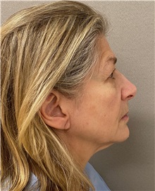 Facelift Before Photo by Keshav Magge, MD; Bethesda, MD - Case 49572