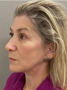 Facelift After Photo by Keshav Magge, MD; Bethesda, MD - Case 49572