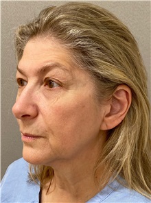 Facelift Before Photo by Keshav Magge, MD; Bethesda, MD - Case 49572