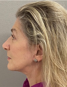 Facelift After Photo by Keshav Magge, MD; Bethesda, MD - Case 49572