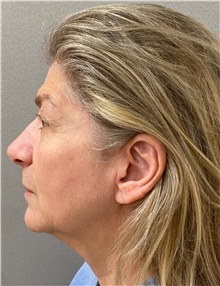 Facelift Before Photo by Keshav Magge, MD; Bethesda, MD - Case 49572