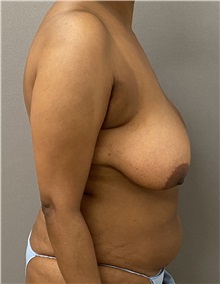 Breast Reduction Before Photo by Keshav Magge, MD; Bethesda, MD - Case 49760