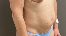 Tummy Tuck Before Photo by Keshav Magge, MD; Bethesda, MD - Case 49776