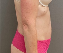 Tummy Tuck After Photo by Keshav Magge, MD; Bethesda, MD - Case 49776