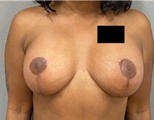 Breast Lift After Photo by Keshav Magge, MD; Bethesda, MD - Case 49930