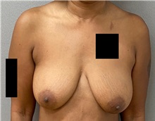 Breast Lift Before Photo by Keshav Magge, MD; Bethesda, MD - Case 49930