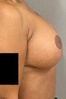 Breast Lift After Photo by Keshav Magge, MD; Bethesda, MD - Case 49930