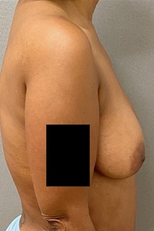 Breast Lift Before Photo by Keshav Magge, MD; Bethesda, MD - Case 49930