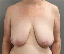 Breast Lift Before Photo by Keshav Magge, MD; Bethesda, MD - Case 49932 Breast Lift Before Photo by Keshav Magge, MD; Bethesda, MD - Case 49932