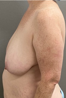 Breast Lift Before Photo by Keshav Magge, MD; Bethesda, MD - Case 49932