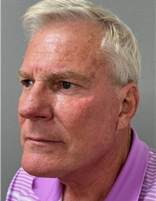 Facelift After Photo by Keshav Magge, MD; Bethesda, MD - Case 49935 Facelift After Photo by Keshav Magge, MD; Bethesda, MD - Case 49935