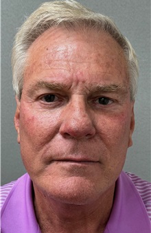 Neck Lift After Photo by Keshav Magge, MD; Bethesda, MD - Case 49934