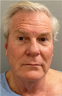 Neck Lift Before Photo by Keshav Magge, MD; Bethesda, MD - Case 49934