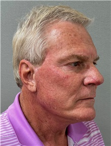 Neck Lift After Photo by Keshav Magge, MD; Bethesda, MD - Case 49934