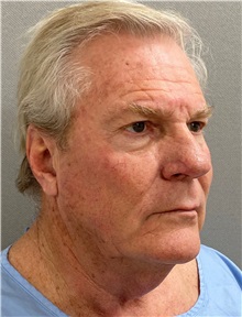 Neck Lift Before Photo by Keshav Magge, MD; Bethesda, MD - Case 49934