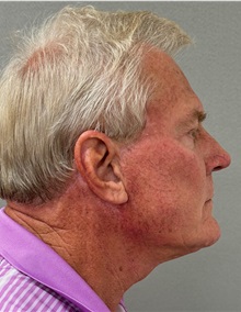 Neck Lift After Photo by Keshav Magge, MD; Bethesda, MD - Case 49934