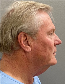 Neck Lift Before Photo by Keshav Magge, MD; Bethesda, MD - Case 49934