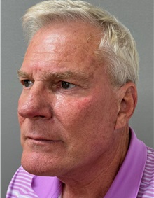 Neck Lift After Photo by Keshav Magge, MD; Bethesda, MD - Case 49934
