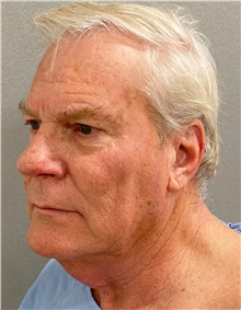 Neck Lift Before Photo by Keshav Magge, MD; Bethesda, MD - Case 49934