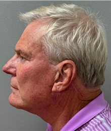 Neck Lift After Photo by Keshav Magge, MD; Bethesda, MD - Case 49934