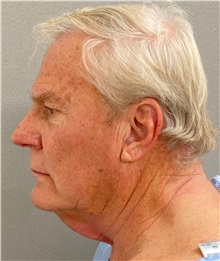Neck Lift Before Photo by Keshav Magge, MD; Bethesda, MD - Case 49934