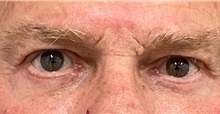 Eyelid Surgery After Photo by Keshav Magge, MD; Bethesda, MD - Case 49936 Eyelid Surgery After Photo by Keshav Magge, MD; Bethesda, MD - Case 49936