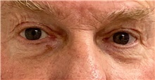 Eyelid Surgery Before Photo by Keshav Magge, MD; Bethesda, MD - Case 49936 Eyelid Surgery Before Photo by Keshav Magge, MD; Bethesda, MD - Case 49936
