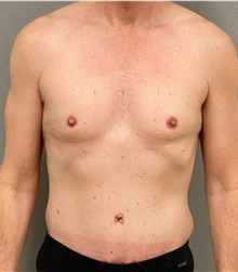 Tummy Tuck After Photo by Keshav Magge, MD; Bethesda, MD - Case 49946 Tummy Tuck After Photo by Keshav Magge, MD; Bethesda, MD - Case 49946