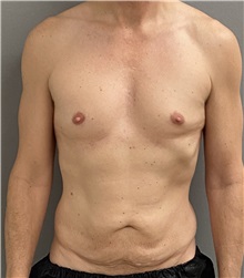 Tummy Tuck Before Photo by Keshav Magge, MD; Bethesda, MD - Case 49946 Tummy Tuck Before Photo by Keshav Magge, MD; Bethesda, MD - Case 49946