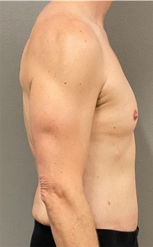 Tummy Tuck After Photo by Keshav Magge, MD; Bethesda, MD - Case 49946