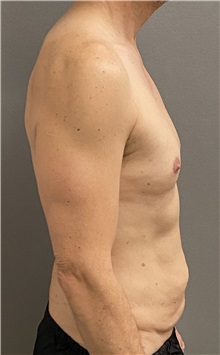 Tummy Tuck Before Photo by Keshav Magge, MD; Bethesda, MD - Case 49946