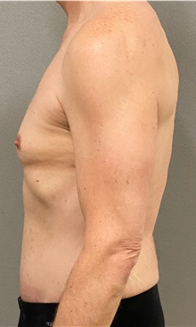 Tummy Tuck After Photo by Keshav Magge, MD; Bethesda, MD - Case 49946