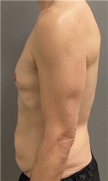 Tummy Tuck Before Photo by Keshav Magge, MD; Bethesda, MD - Case 49946