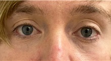 Eyelid Surgery After Photo by Keshav Magge, MD; Bethesda, MD - Case 49947 Eyelid Surgery After Photo by Keshav Magge, MD; Bethesda, MD - Case 49947