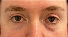 Eyelid Surgery Before Photo by Keshav Magge, MD; Bethesda, MD - Case 49947 Eyelid Surgery Before Photo by Keshav Magge, MD; Bethesda, MD - Case 49947