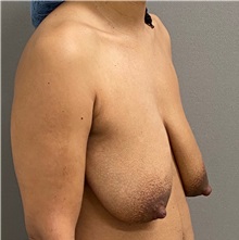 Breast Lift Before Photo by Keshav Magge, MD; Bethesda, MD - Case 49945