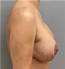 Breast Lift After Photo by Keshav Magge, MD; Bethesda, MD - Case 49945